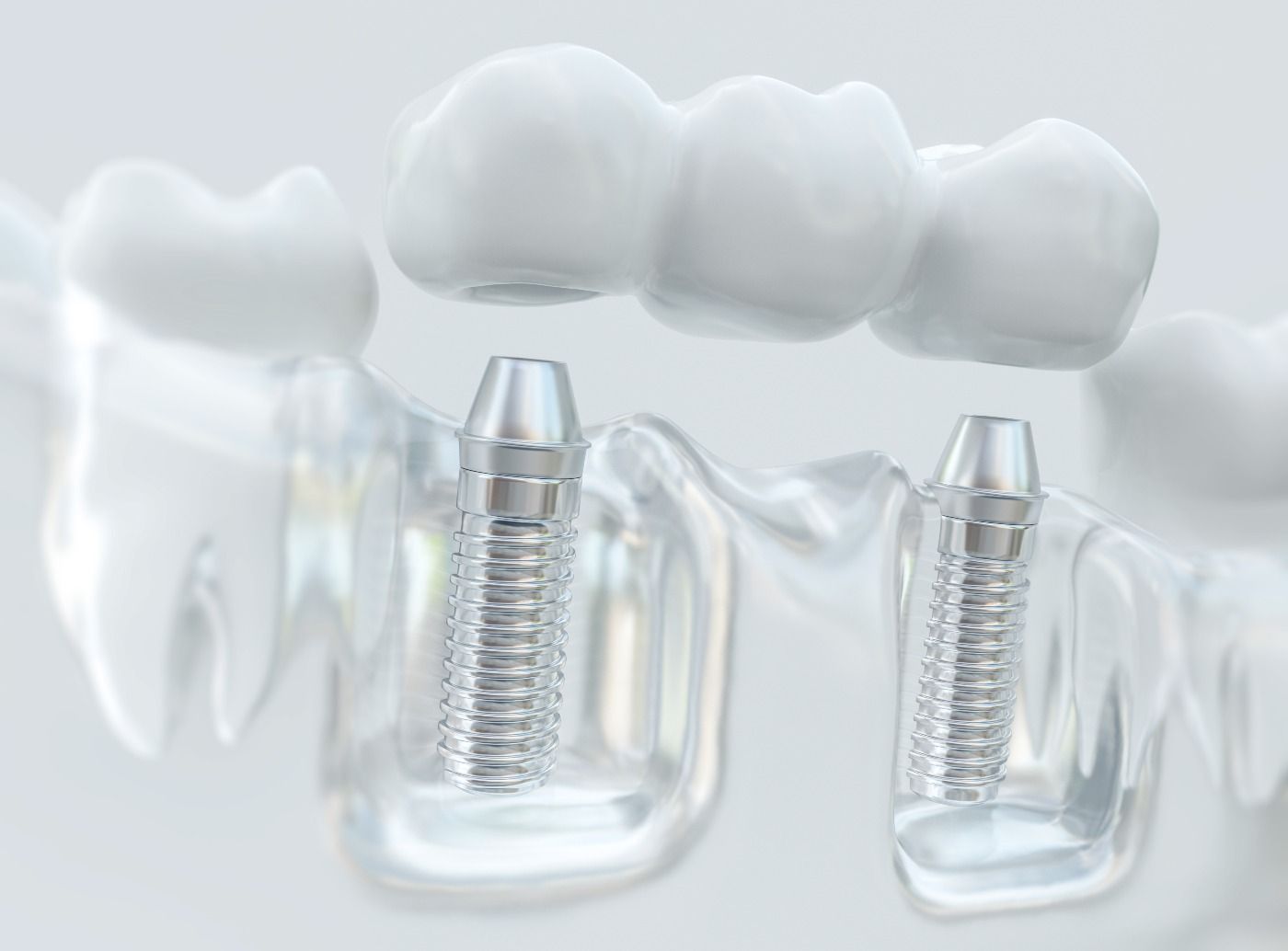 Restorative dentistry in Naperville