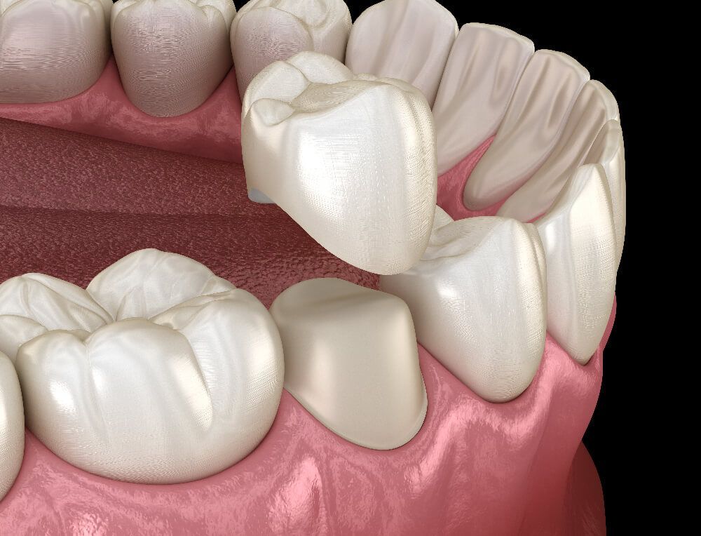 Dental crown treatment in Naperville