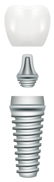 Dental implant in Naperville