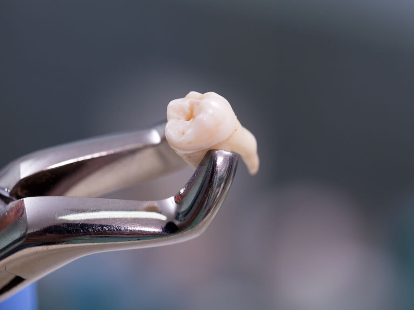 Tooth extractions in Naperville