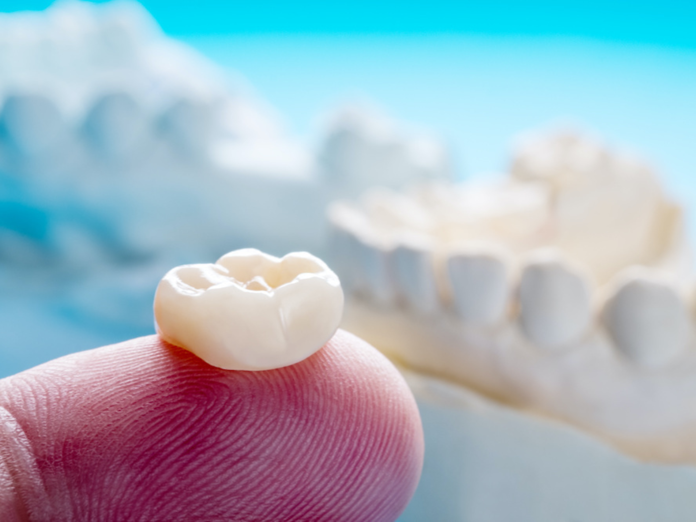 Dental crowns in Naperville
