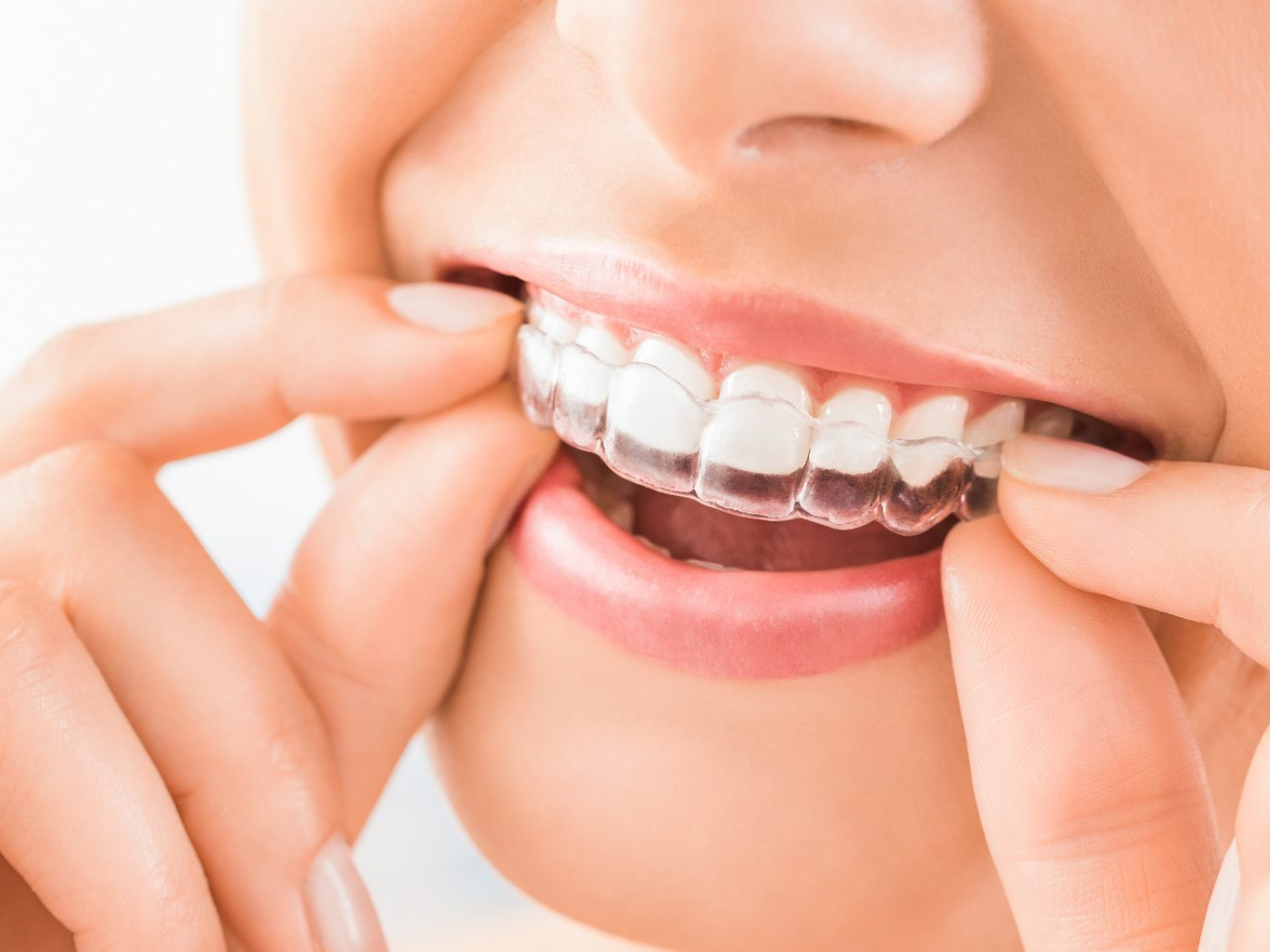 SureSmile clear aligners in Naperville